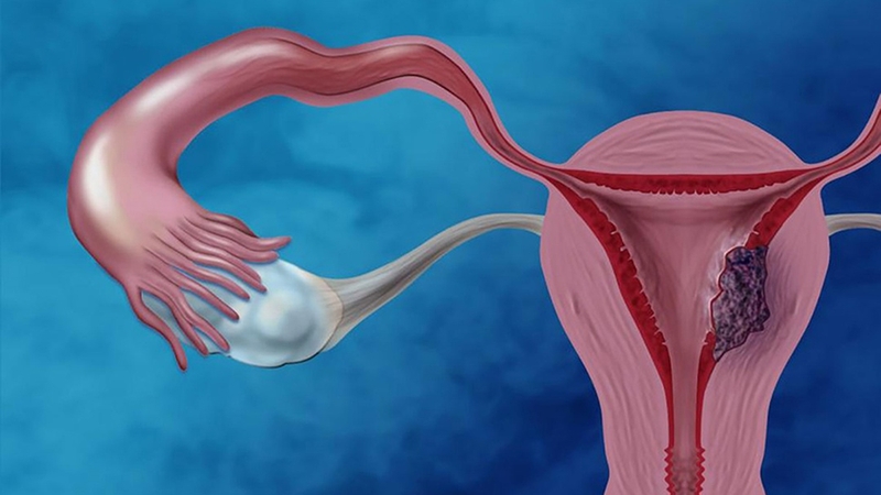 Phát hiện buồng trứng phải có nang 19mm có cần mổ không? 1