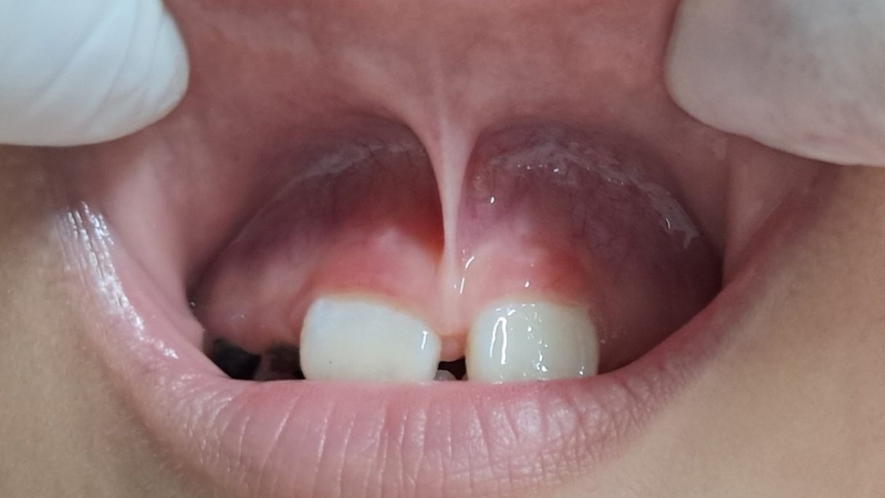 Phát hiện phanh môi bám thấp ở trẻ cần xử lý như nào 1