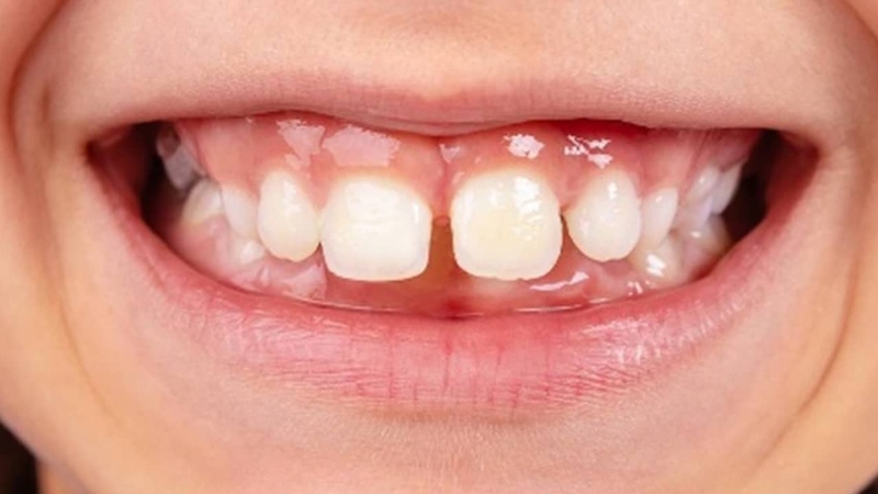 Phát hiện phanh môi bám thấp ở trẻ cần xử lý như nào 2