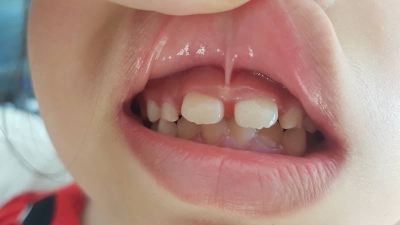 Phát hiện phanh môi bám thấp ở trẻ cần xử lý như nào 3