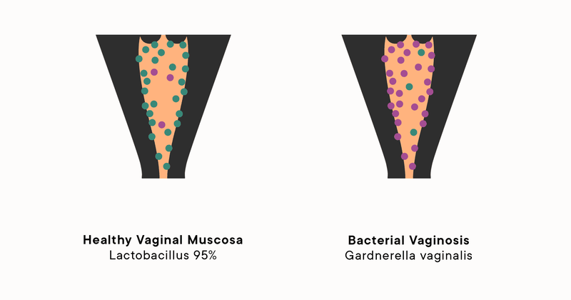 Phát hiện sớm 4 dấu hiệu viêm âm đạo cực đơn giản tại nhà! 2
