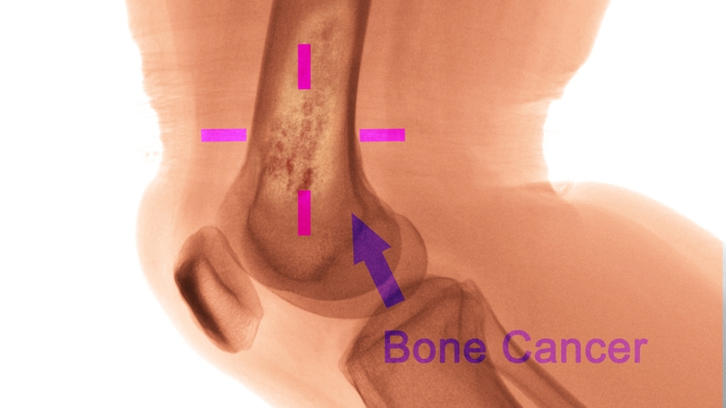 Phát hiện sớm là chìa khóa để kiểm soát ung thư xương 1