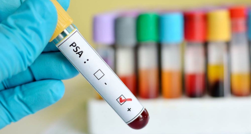 Phát hiện sớm ung thư tuyến tiền liệt 2