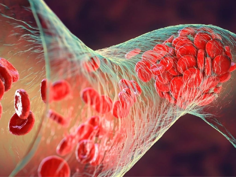 Phát hiện và phương pháp điều trị huyết khối tĩnh mạch cửa trong xơ gan 1