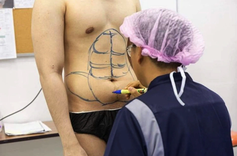 Phẫu thuật 6 múi: Thông tin từ A đến Z về phương pháp thẩm mỹ này! 2