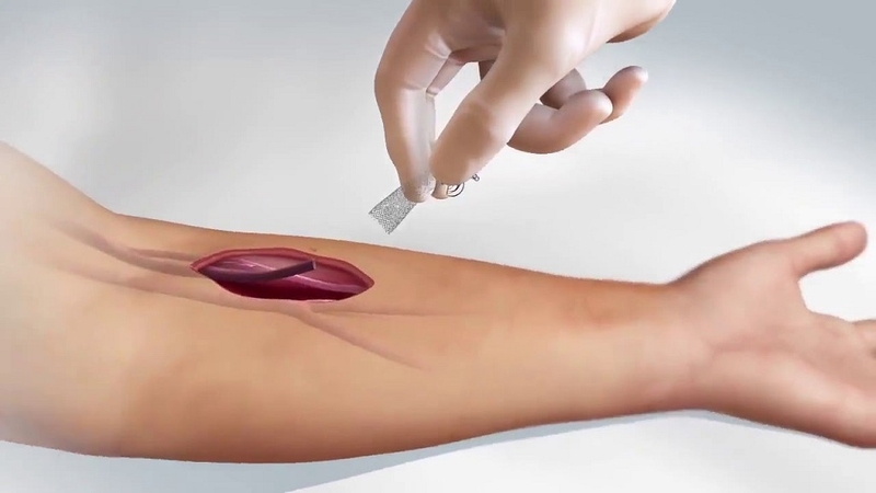 Phẫu thuật AVF và những điều cần biết 2