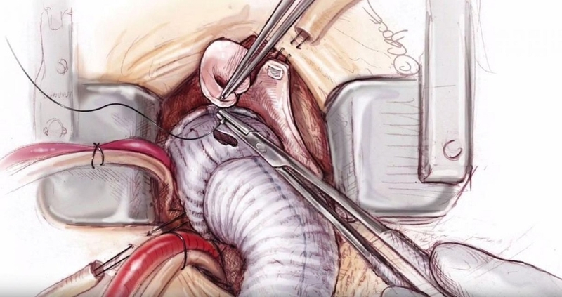 Phẫu thuật Bentall và những kiến thức cần biết 2