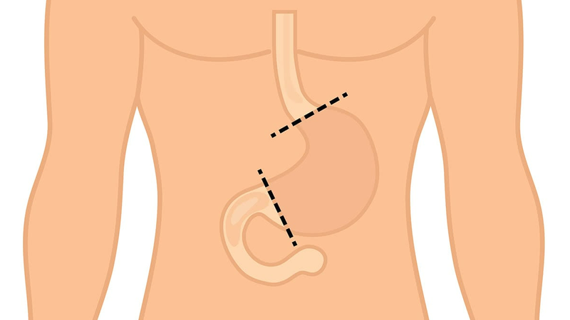 Phẫu thuật cắt ⅔ dạ dày nội soi được chỉ định khi nào?1