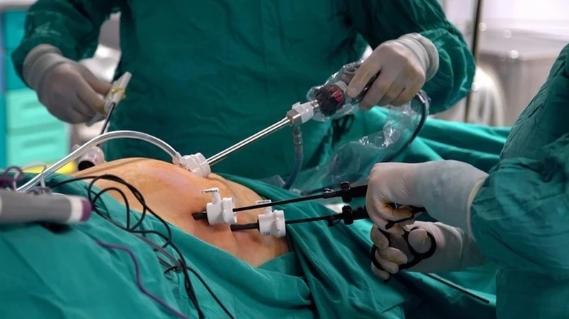 Phẫu thuật cắt dạ dày bao nhiêu tiền? Cách chăm sóc sau khi mổ 1