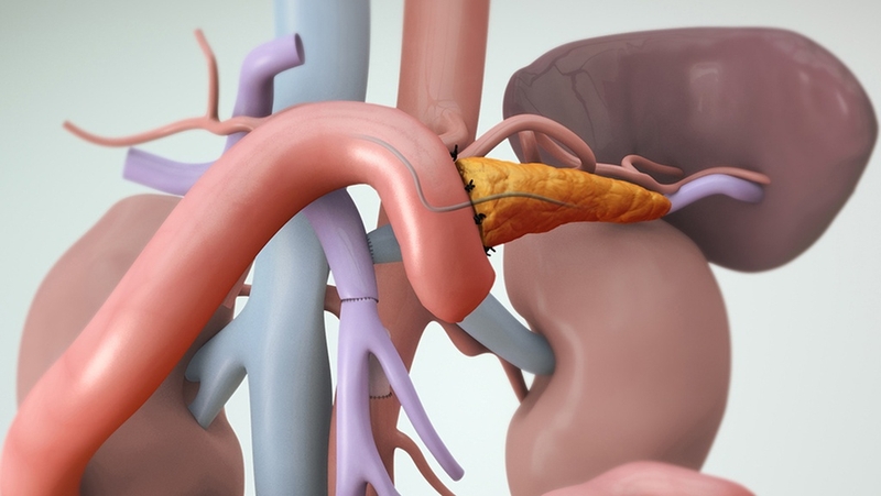 Phẫu thuật cắt khối tá tụy và những điều cần biết 5