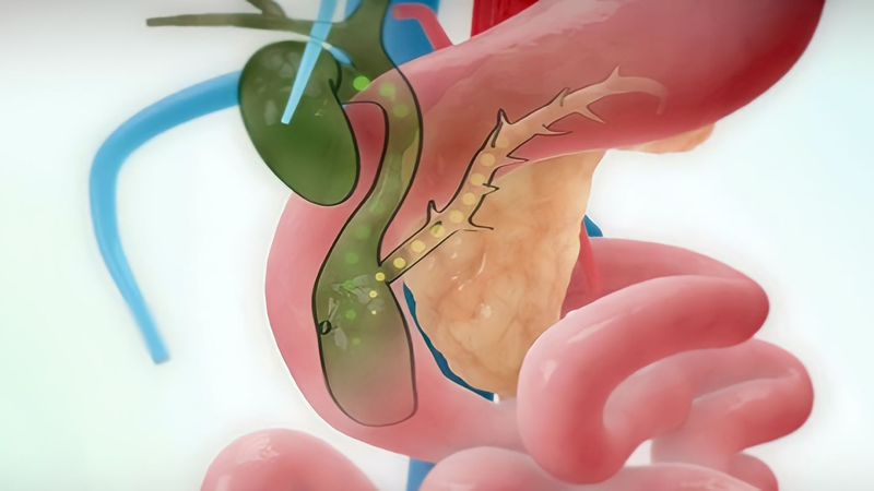 phau-thuat-cat-nang-ong-mat-chu-la-gi 1.jpg