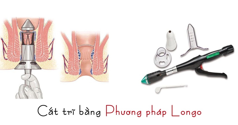 phau-thuat-cat-tri-co-phai-nam-vien-khong-2.jpg