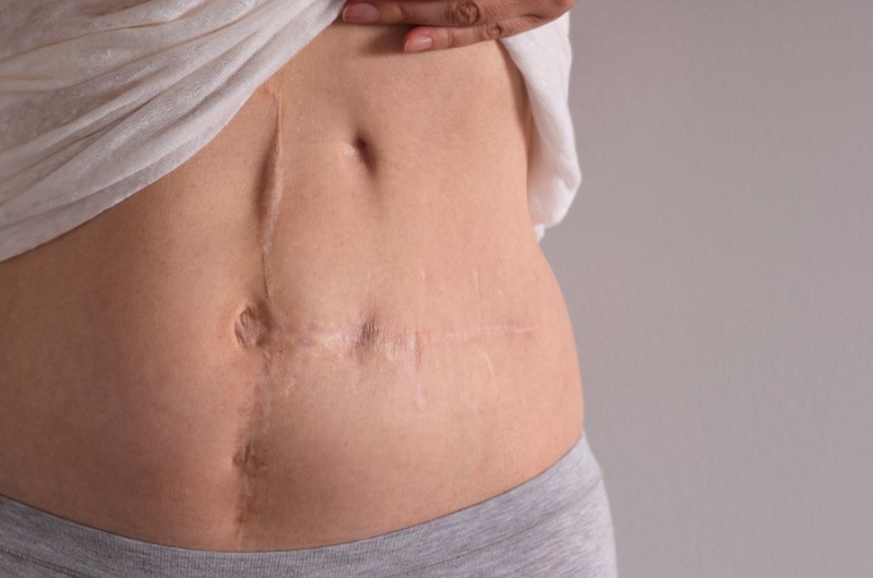 Tìm hiểu chi tiết về phẫu thuật cắt tử cung 3