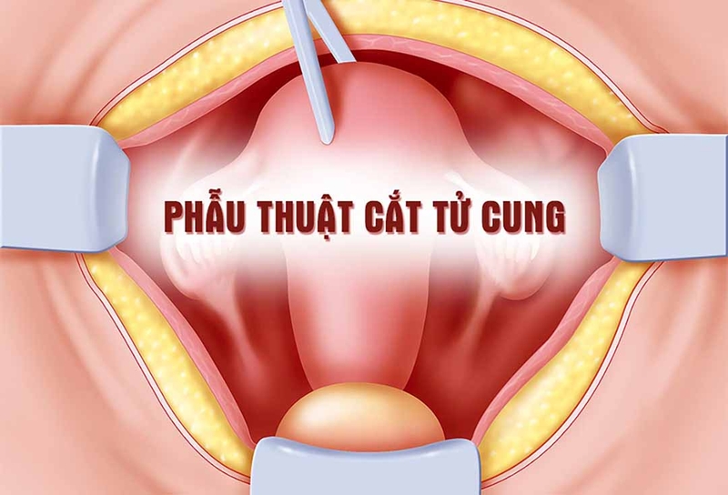 Phương pháp điều trị và ngăn ngừa bệnh sa tử cung sau sinh 2