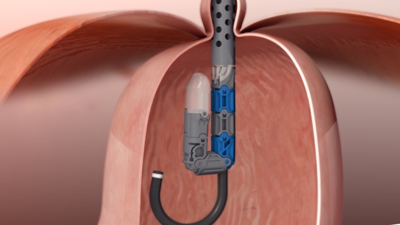 Phẫu thuật điều trị trào ngược dạ dày thực quản và những điều cần biết 4