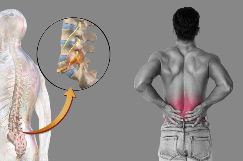 Tìm hiểu về phương pháp phẫu thuật điều trị trượt đốt sống 2