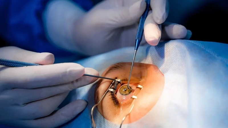 Phẫu thuật đục thủy tinh thể chuẩn bị gì? 3