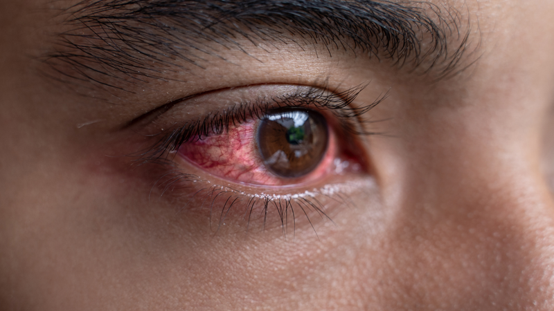 Phẫu thuật Epicanthus tạo hình để giải quyết vấn đề lông mi chạm vào giác mạc 1