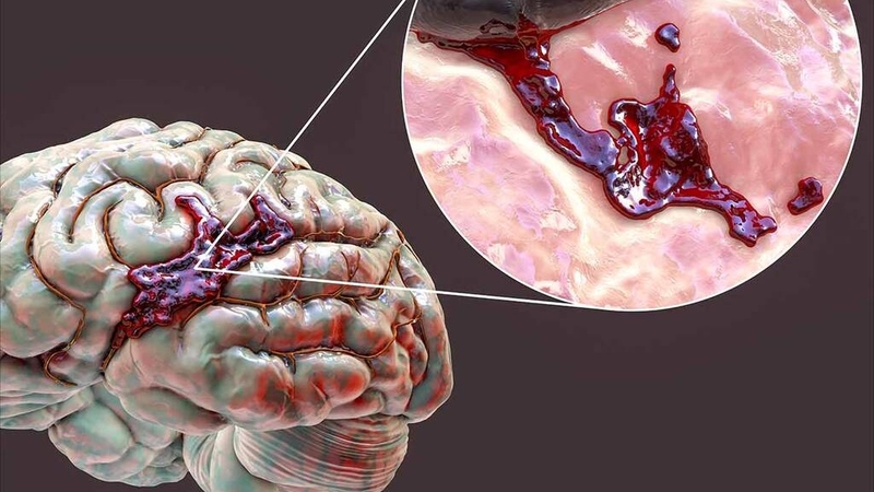 Phẫu thuật giảm áp trong đột quỵ xuất huyết não được chỉ định trong trường hợp nào?  1