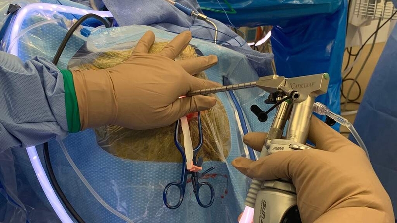 Phẫu thuật giảm áp trong đột quỵ xuất huyết não được chỉ định trong trường hợp nào?  4