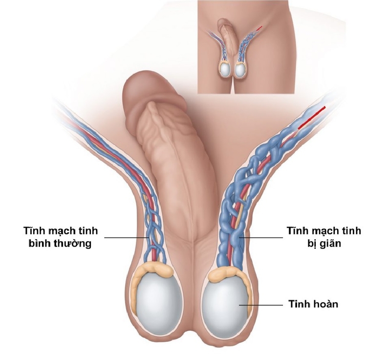 Phẫu thuật giãn tĩnh mạch thừng tinh: Những thông tin cần biết 1