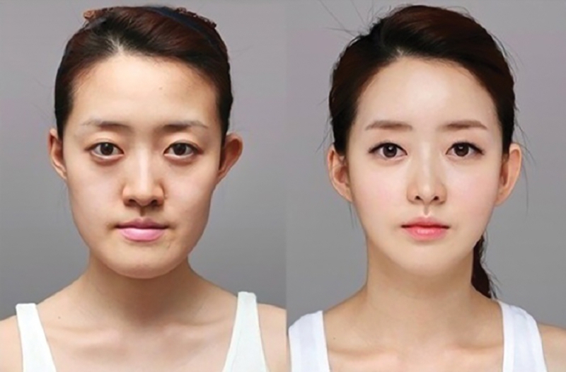 Phẫu thuật gọt hàm bao lâu thì hết sưng? 1