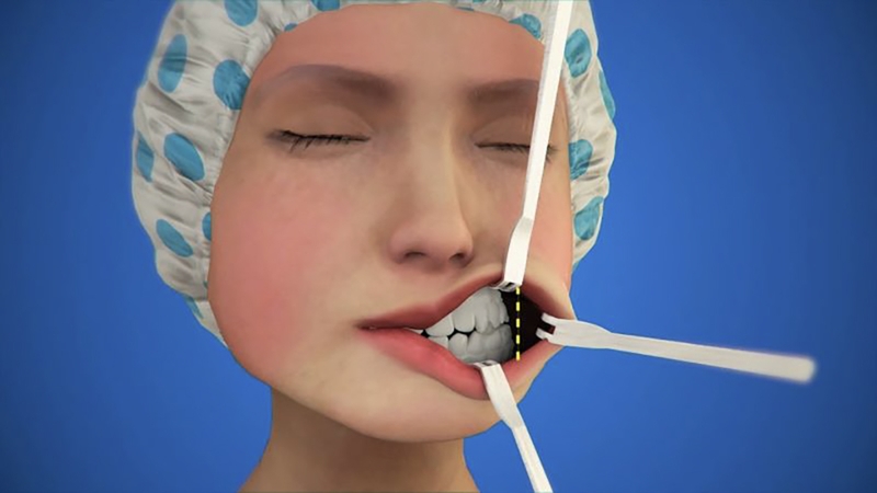 Phẫu thuật gọt hàm bao lâu thì hết sưng? 2