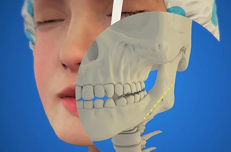 Phẫu thuật gọt hàm bao lâu thì hết sưng? 3