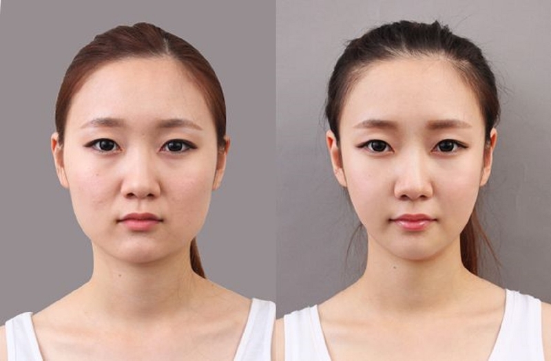 Phẫu thuật gọt hàm V-line có nguy hiểm không? 2