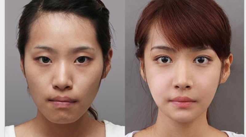 Phẫu thuật hàm hô bao lâu thì lành? Những lưu ý sau khi thực hiện? 3