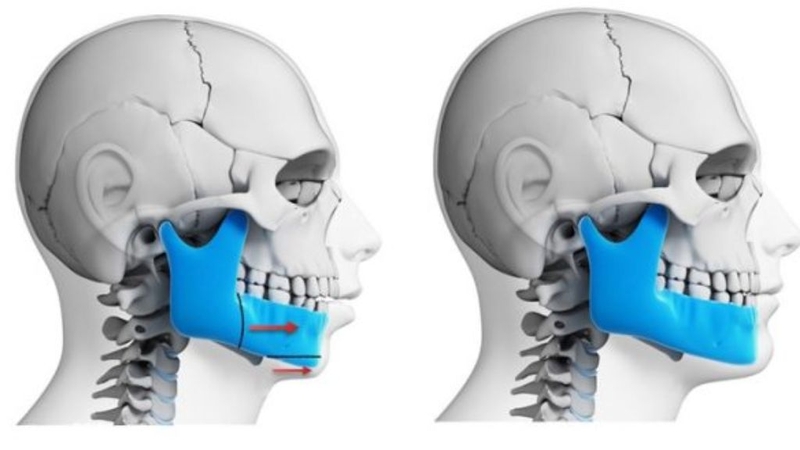 Phẫu thuật hàm móm bao lâu thì lành? Cần lưu ý điều gì? 2