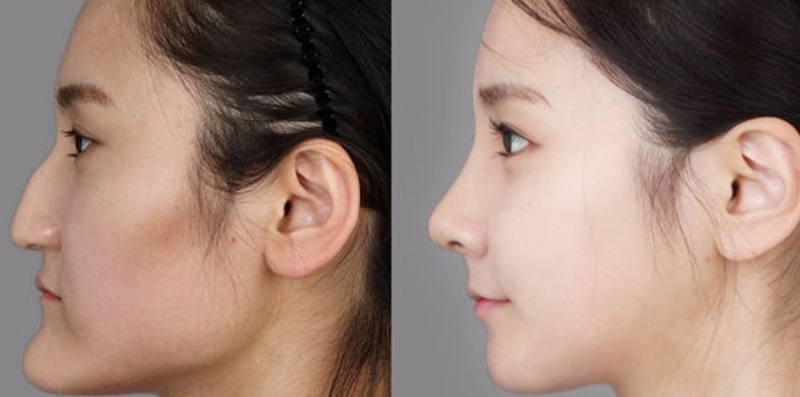 Phẫu thuật hàm móm có phức tạp không? 1