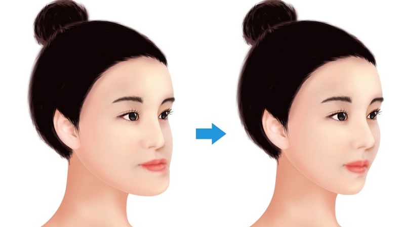 Phẫu thuật hàm móm có nguy hiểm không? Tìm hiểu về lợi ích và rủi ro 2