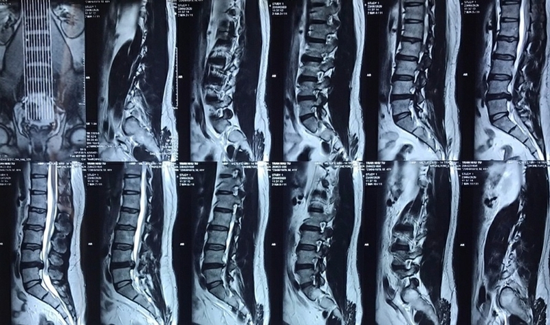 Phẫu thuật hẹp ống sống diễn ra như thế nào? Khi nào cần phẫu thuật? 3