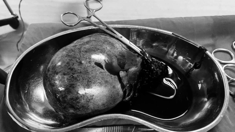 Khối u và vòi tử cung phải đã xoắn 3 vòng, toàn bộ phần phụ tím đen do hoại tử