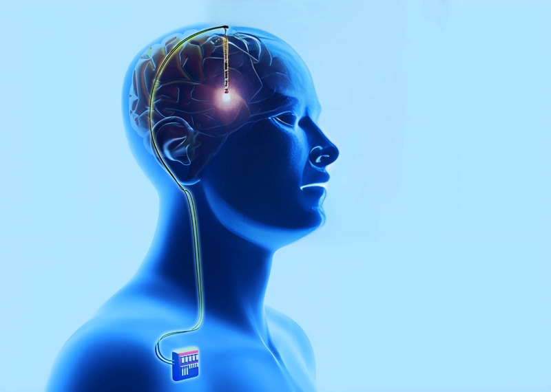 Phẫu thuật kích thích não sâu được chấp thuận lần đầu tiên vào năm 1997 để điều trị triệu chứng run do bệnh Parkinson