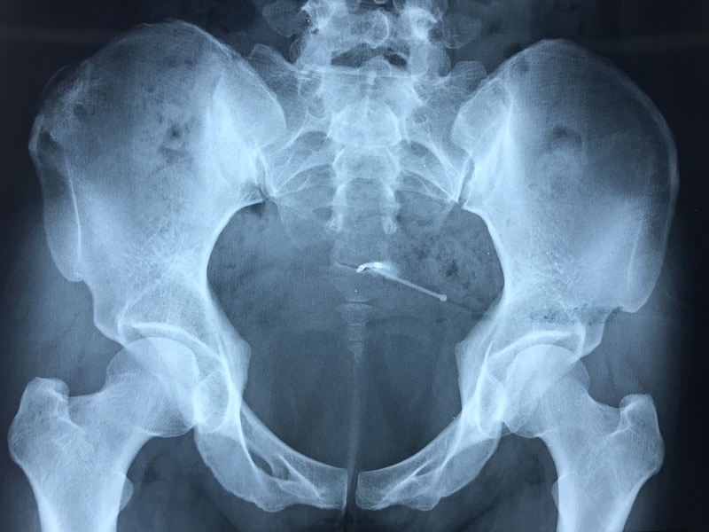 Phẫu thuật lấy vòng tránh thai là gì? Khi nào cần thực hiện? 2