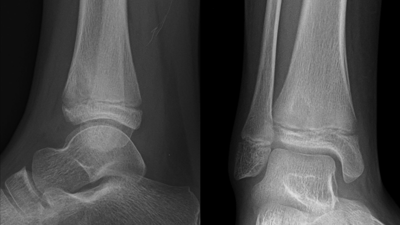 Phẫu thuật lấy xương chết và phương pháp thực hiện cơ bản 2