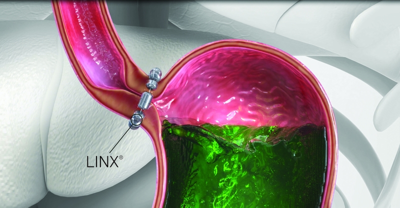 Phẫu thuật Linx là gì? 5 phương pháp phẫu thuật trào ngược dạ dày 3