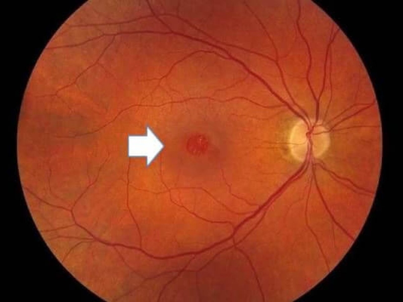 Phẫu thuật lỗ hoàng điểm và những điều cần biết 1