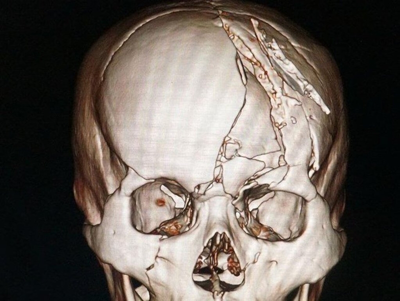 phau-thuat-lun-xuong-so-khong-co-chan-thuong-duoc-thuc-hien-nhu-the-nao 1.jpg