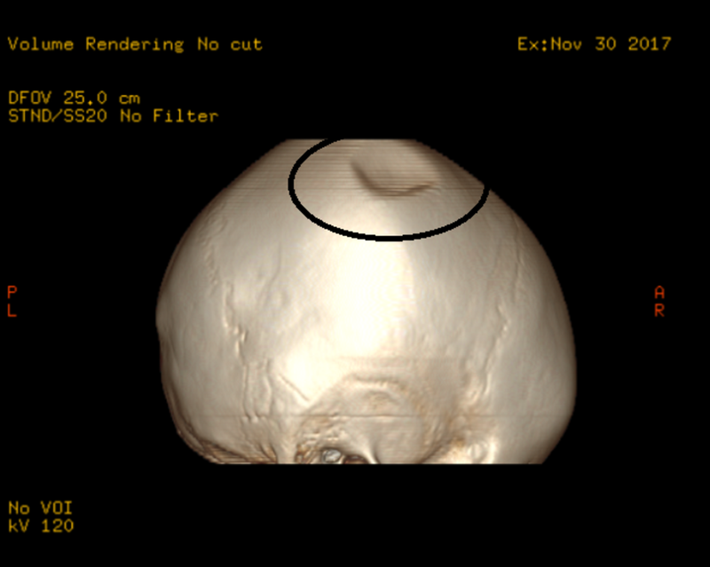 phau-thuat-lun-xuong-so-khong-co-chan-thuong-duoc-thuc-hien-nhu-the-nao 2.png