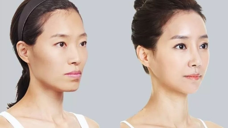 Phẫu thuật miệng cười: Phương pháp can thiệp được ưa chuộng! 2