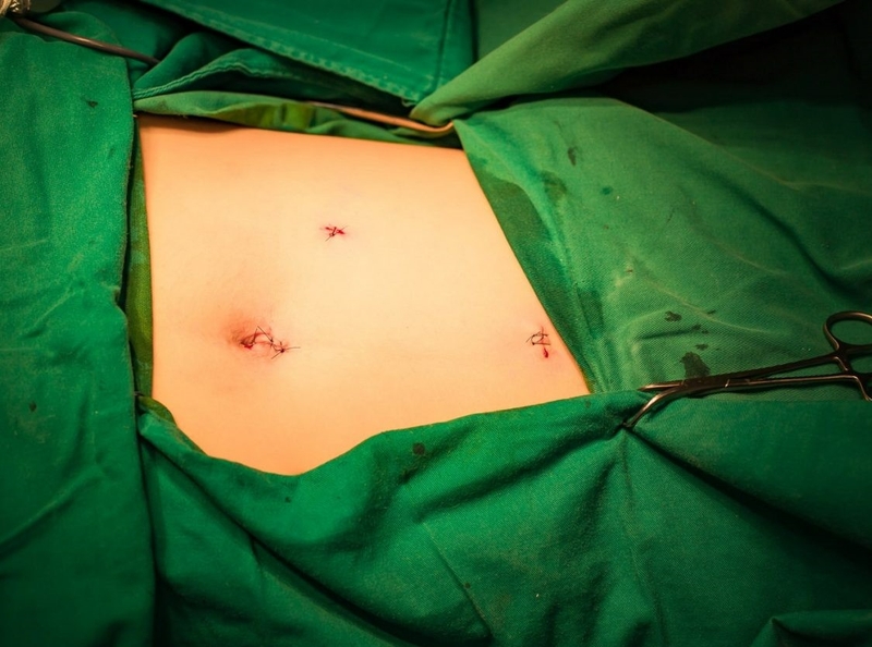 Phẫu thuật nội soi cắt túi mật cần chú ý gì? 4