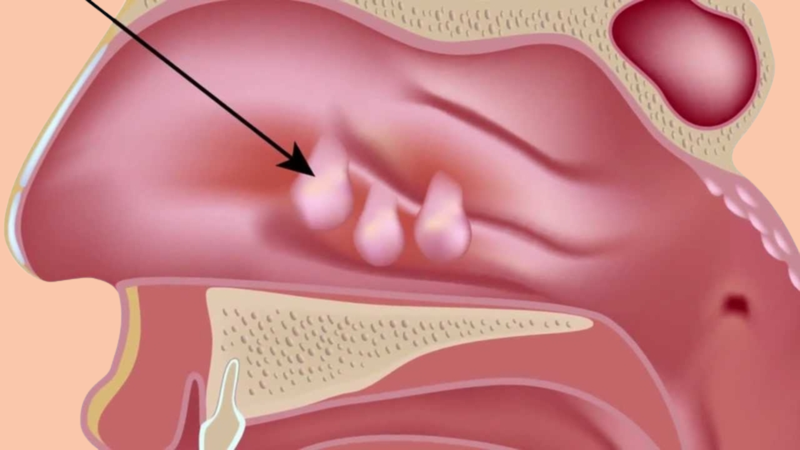 Phẫu thuật nội soi mũi xoang FESS giúp loại bỏ các khối polyp mũi và mở rộng đường thở