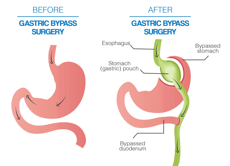 Phẫu thuật nối tắt dạ dày và những điều cần biết 2