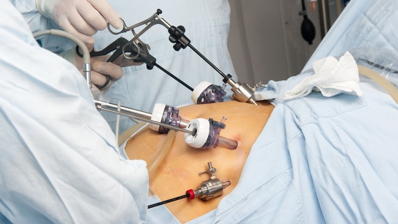 Phẫu thuật nối tắt dạ dày và những điều cần biết 3