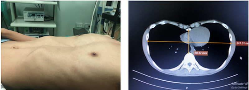 Phẫu thuật Nuss và những điều cần biết 1