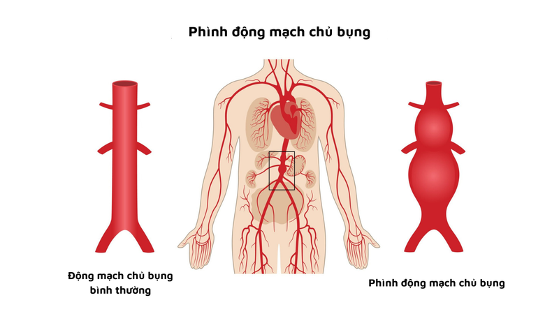 Phẫu thuật phình động mạch chủ bụng dưới thận 1