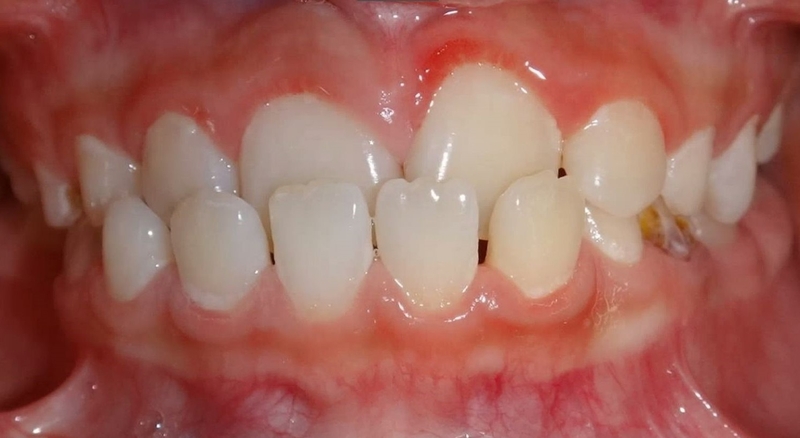 Phẫu thuật răng hô và cách chăm sóc sau phẫu thuật 3